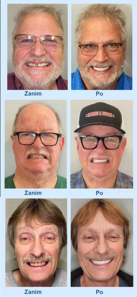 doskonały zestaw do protez(biomimetyczna konstrukcja dziąseł, wygodna bez szlifowania ust, dzięki czemu protezy tworzą "drugi zestaw prawdziwych zębów")