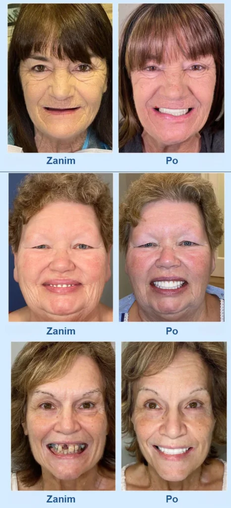 doskonały zestaw do protez(biomimetyczna konstrukcja dziąseł, wygodna bez szlifowania ust, dzięki czemu protezy tworzą "drugi zestaw prawdziwych zębów")